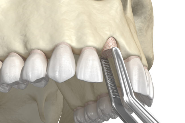 Illustration on bone grafting and tooth implantation