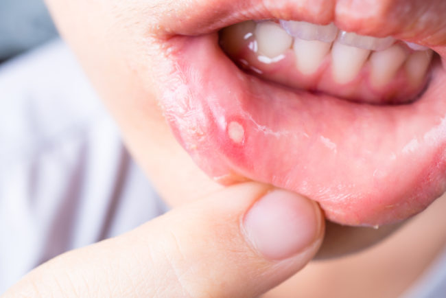 Close up of a womans canker sore on her bottom lip