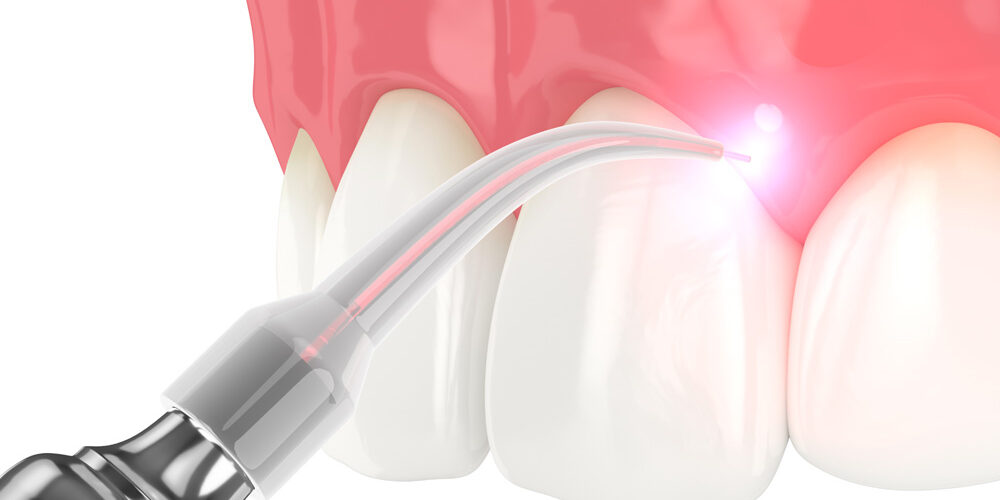 dental diode laser used to treat gums