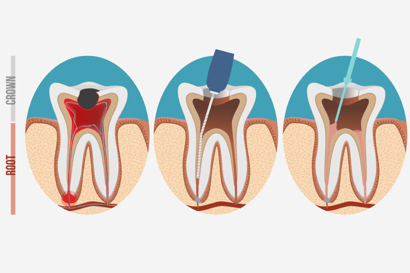 Retreatment of Failed Root Canals Exploring Surgical Options