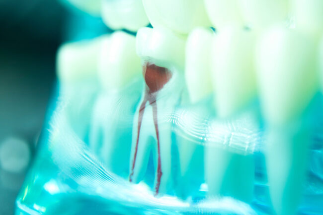 Dental tooth root canal