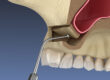 Sinus Lift Surgery