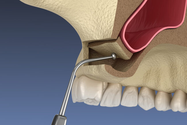 Sinus Lift Surgery
