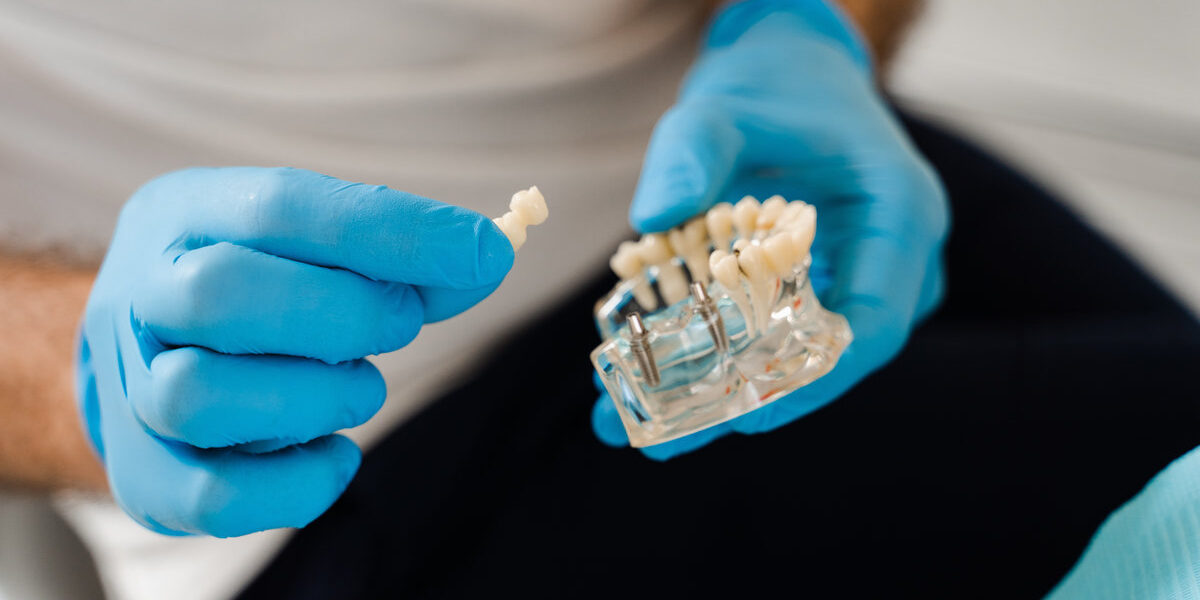 Artificial plastic jaw with dental implants close-up. Dental prosthetics and implants. Dental prosthetics consultation with dentist for patient woman in dentistry