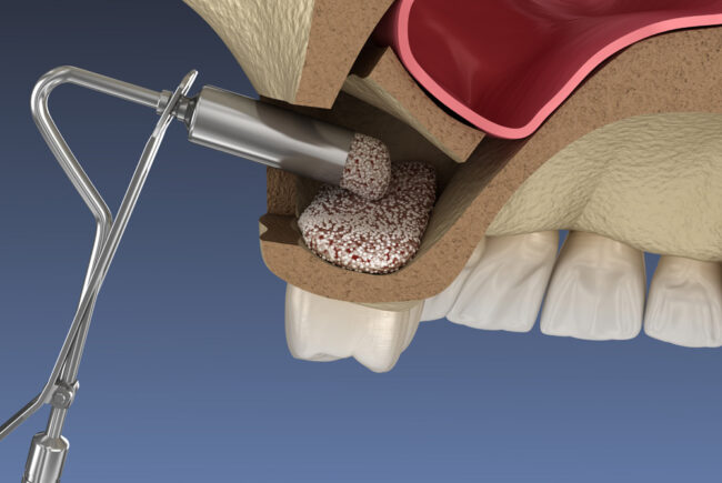 Sinus Lift Sinus Lift