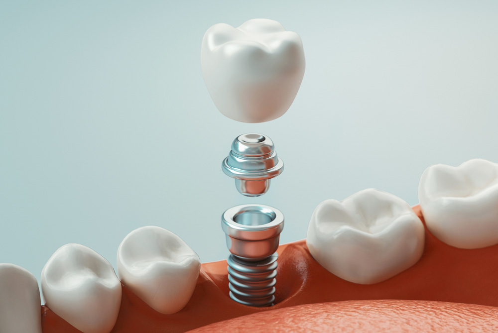 dental implants
