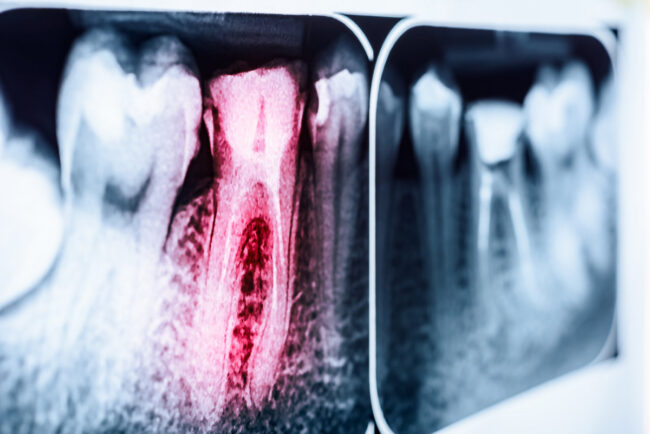 Pain Of Tooth Decay On Teeth X-Ray Pain Of Tooth Decay On Teeth X-Ray