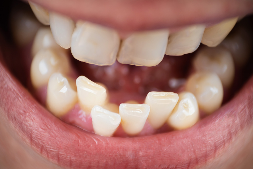 Can Crooked Teeth Cause Gum Problems Rockland Dental Specialists