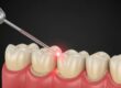 Laser treatment being performed on teeth in a dental procedure