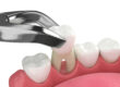 3d render of lower jaw with tooth extraction