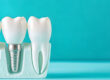 Dental Implants - A Modern Solution for Missing Teeth