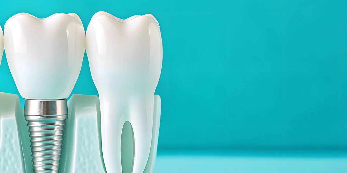 Dental Implants - A Modern Solution for Missing Teeth