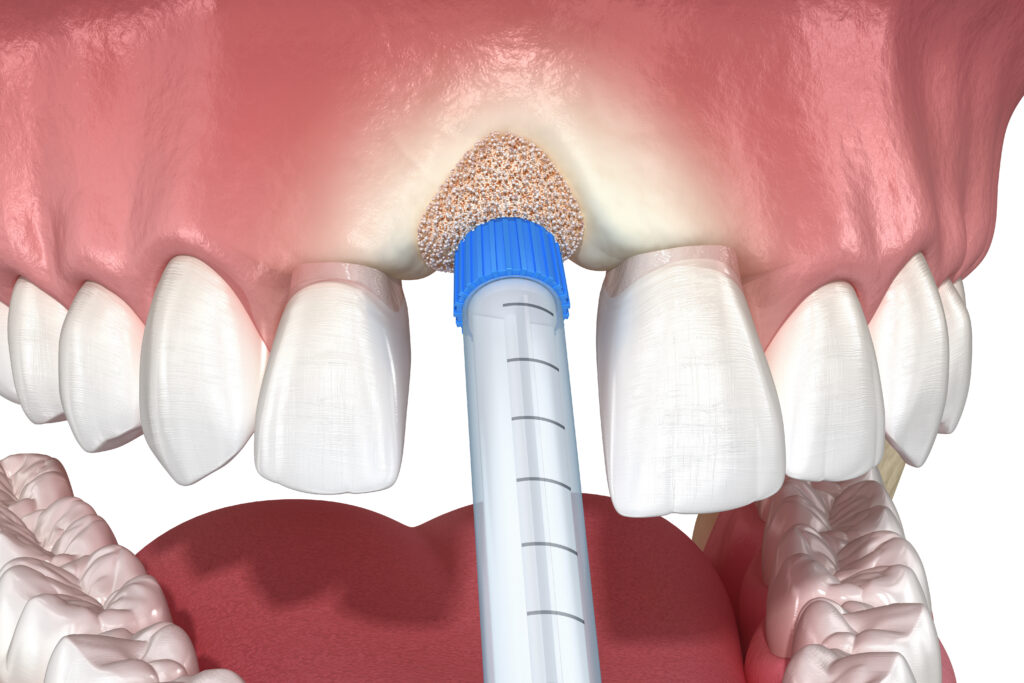 Socket Preservation New City, NY | Rockland Dental Specialist