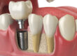 Anatomy of healthy teeth and tooth dental implant in human dentu