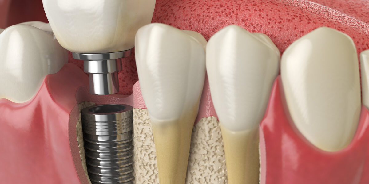Anatomy of healthy teeth and tooth dental implant in human dentu Anatomy of healthy teeth and tooth dental implant in human dentura. 3d illustration