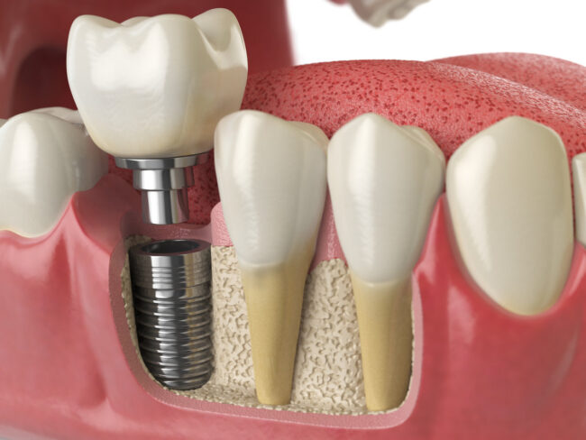 Anatomy of healthy teeth and tooth dental implant in human dentu Anatomy of healthy teeth and tooth dental implant in human dentura. 3d illustration