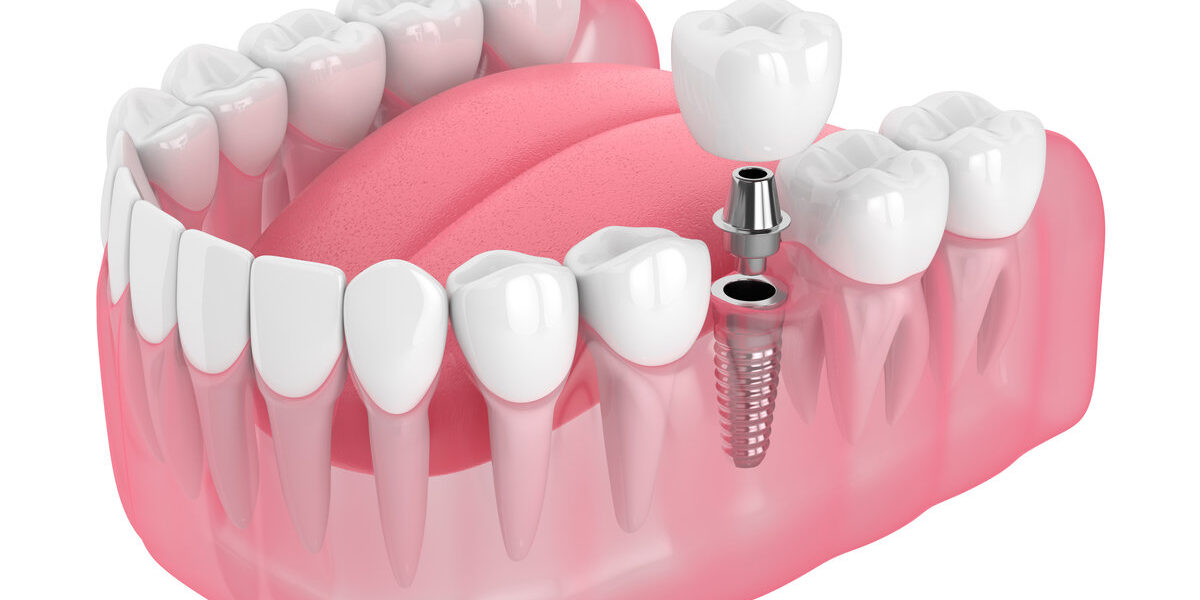3d render of jaw with dental implant 3d render of jaw with dental implant isolated over white background