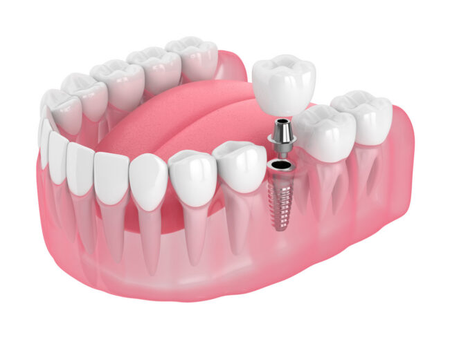 3d render of jaw with dental implant 3d render of jaw with dental implant isolated over white background