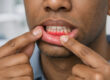 Patient Pointing at Red Gums in Dental Office, Periodontal Disease Concept