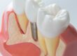 Dental implant model illustrating immediate implant replacement after tooth extraction