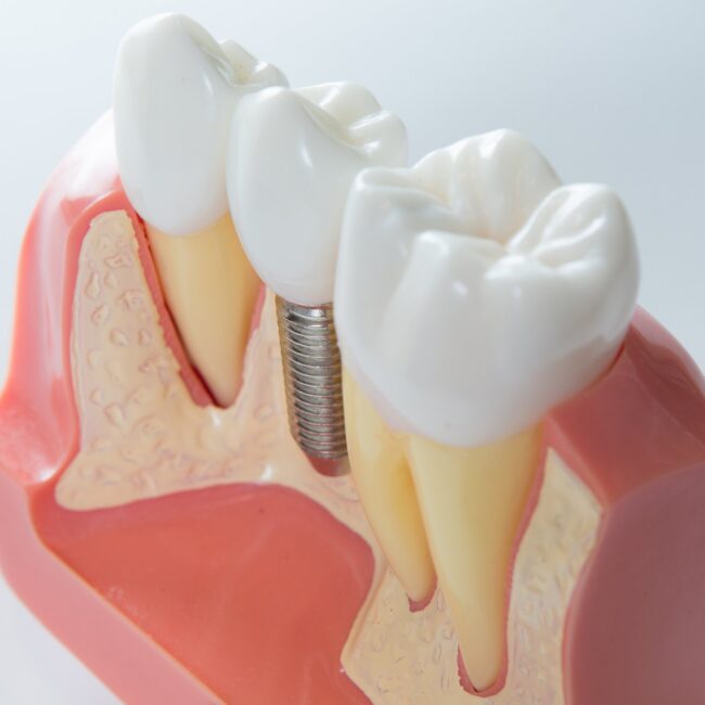 image-1786092815777 Dental implant model illustrating immediate implant replacement after tooth extraction